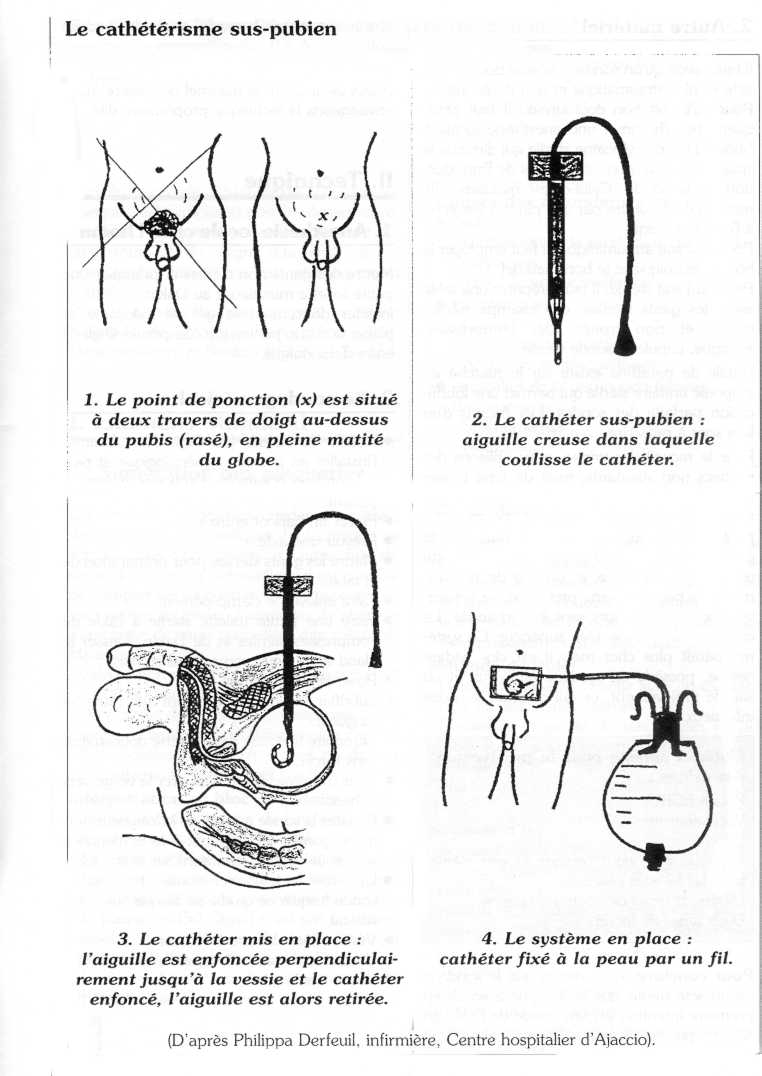 Sonde urinaire : Définition, Types et Indications