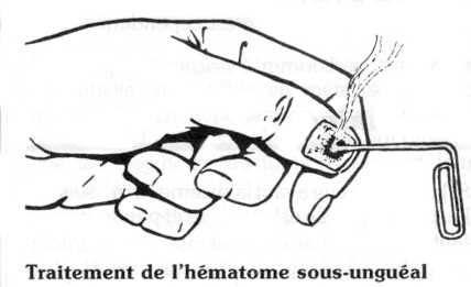 Traumatisme de la troisième phalange des doigts · devsante.org